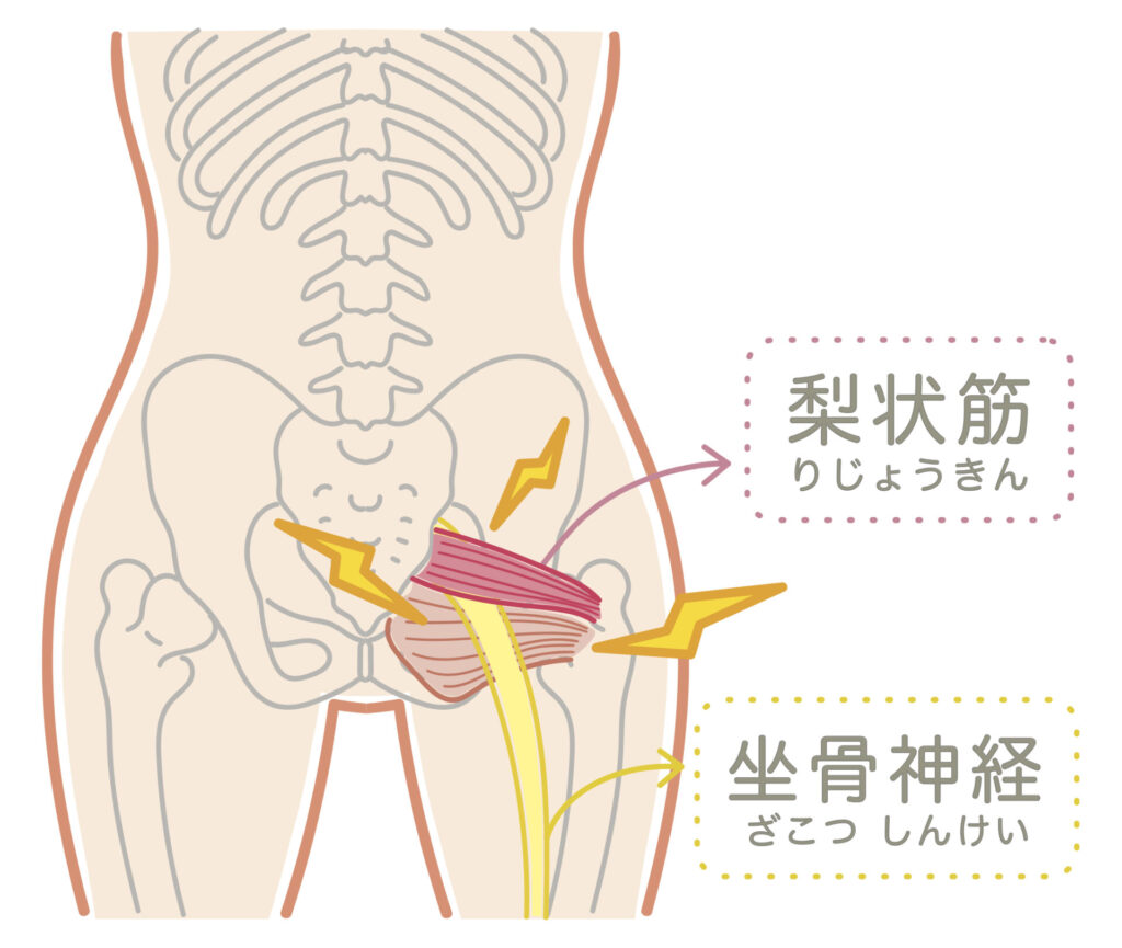 坐骨神経痛　滋賀県大津市　あゆは整体院　脊柱管狭窄症　腰痛　